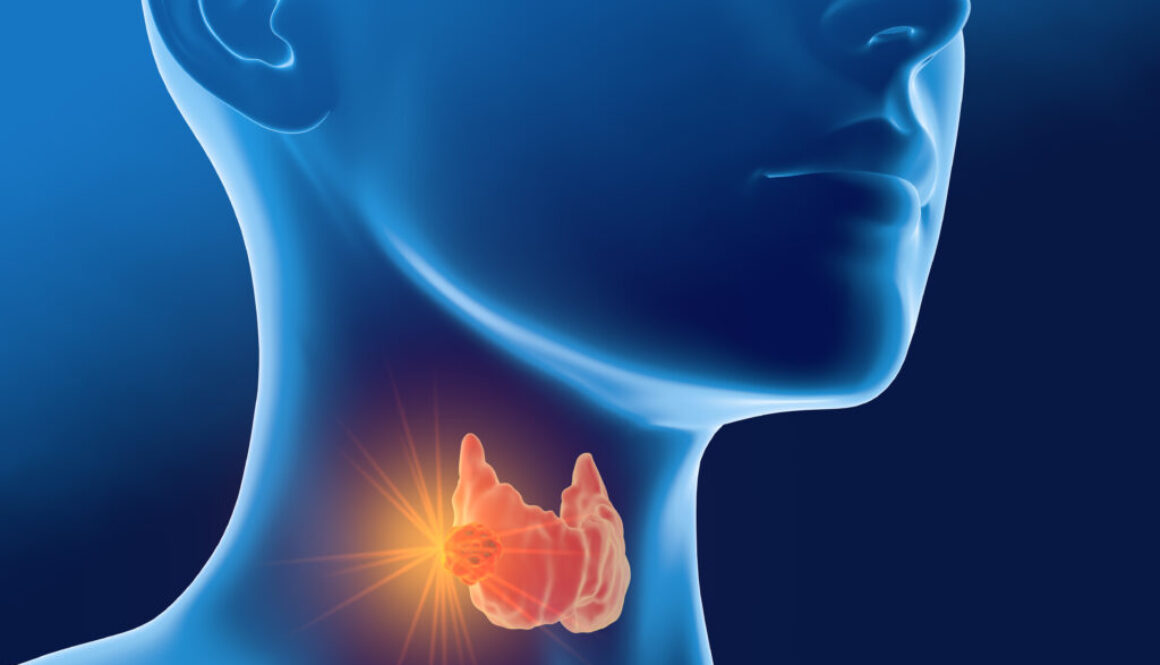 Thyroid cancer of a woman, medically 3D illustration, front view Thyroid cancer graphic