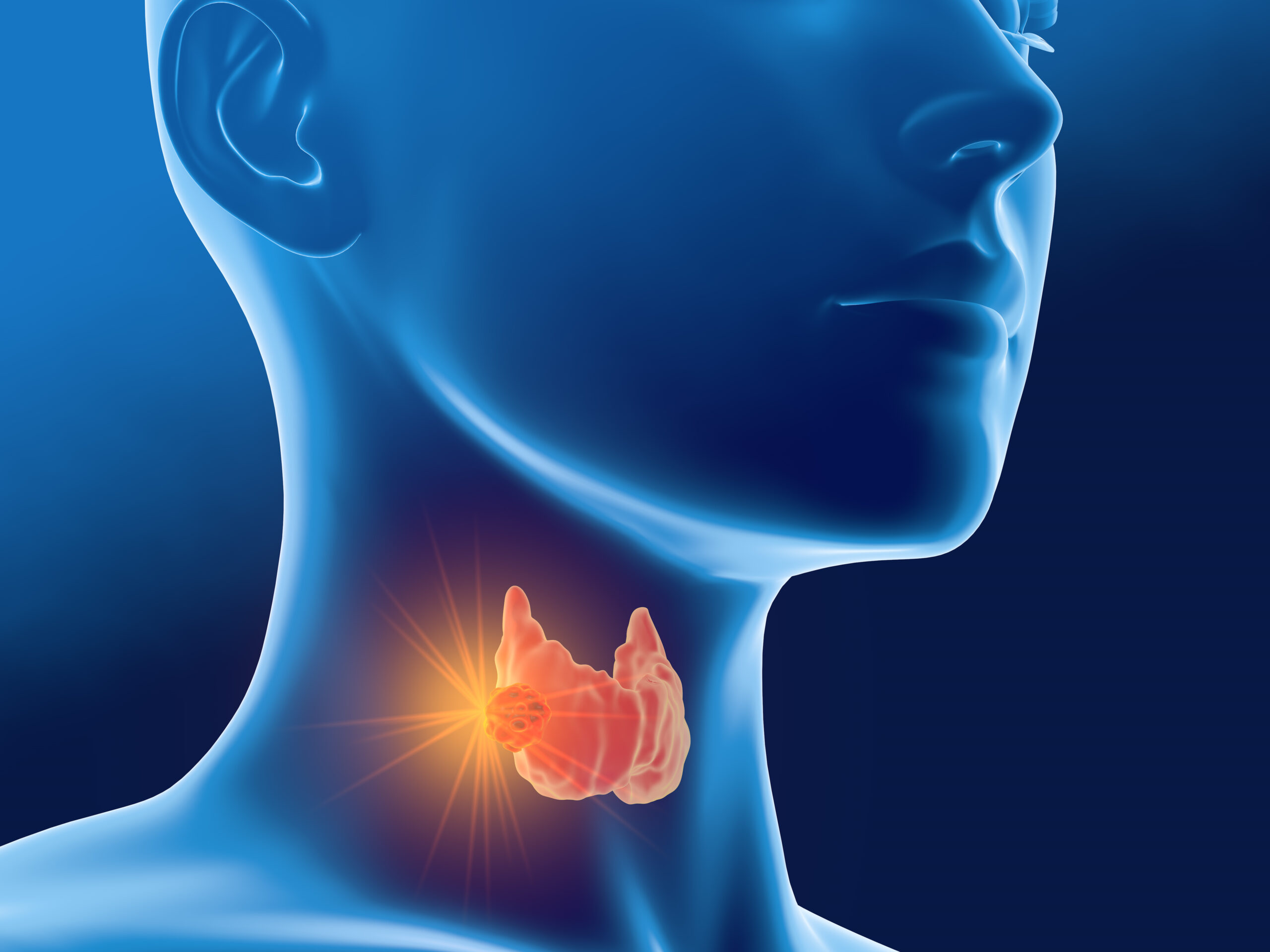 Thyroid cancer graphic